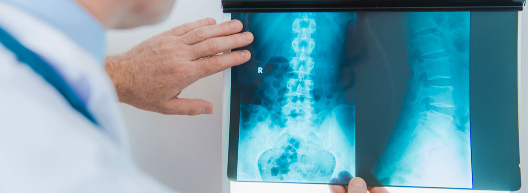 Read more about the article Conheça as diferenças entre cirurgia minimamente invasiva e cirurgia tradicional da coluna vertebral.