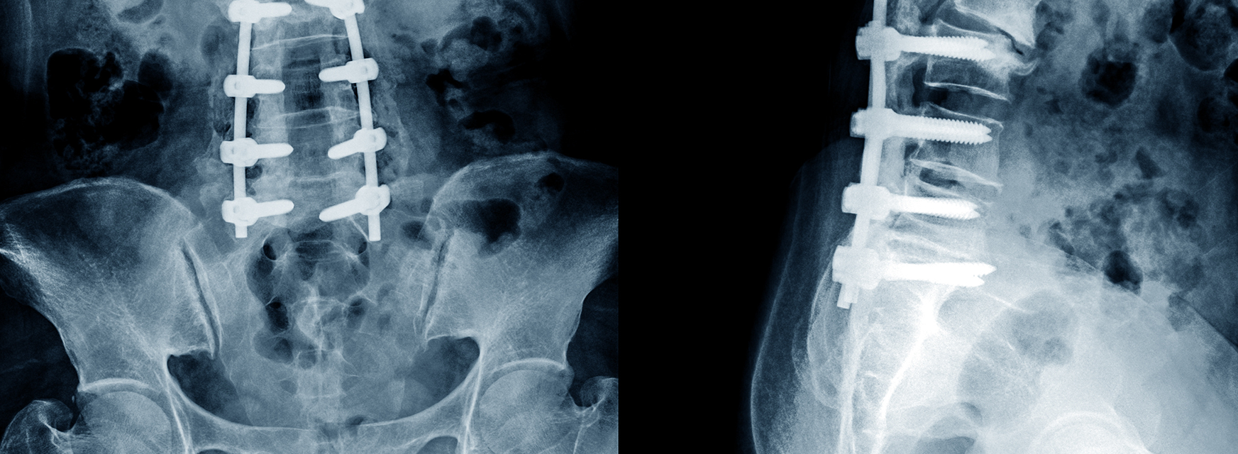 Read more about the article Entendendo a espondilolistese e como a cirurgia pode ajudar!